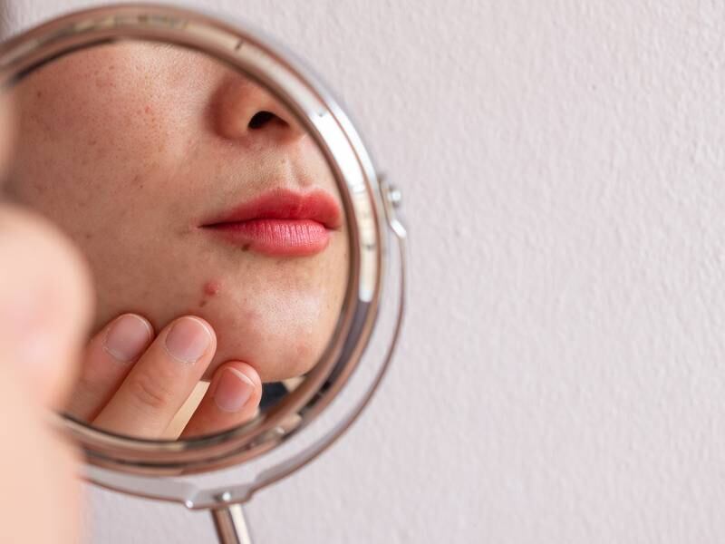 Period Face: the dermatologist’s advice on ‘the big spot’
