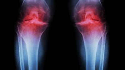 The benefits of exercise with . . . osteoarthritis